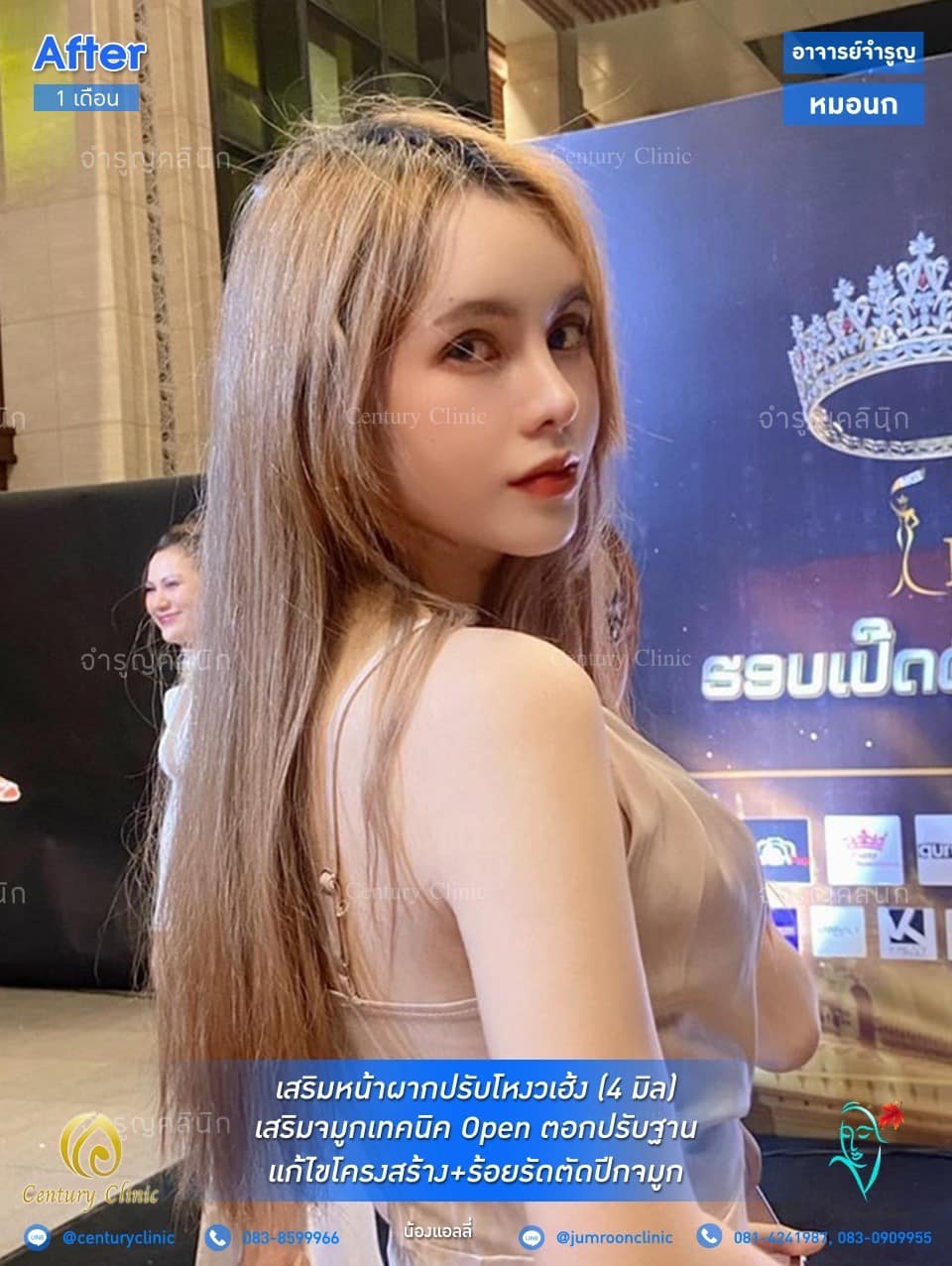 รีวิว เสริมหน้าผากปรับโหงวเฮ้ง #12