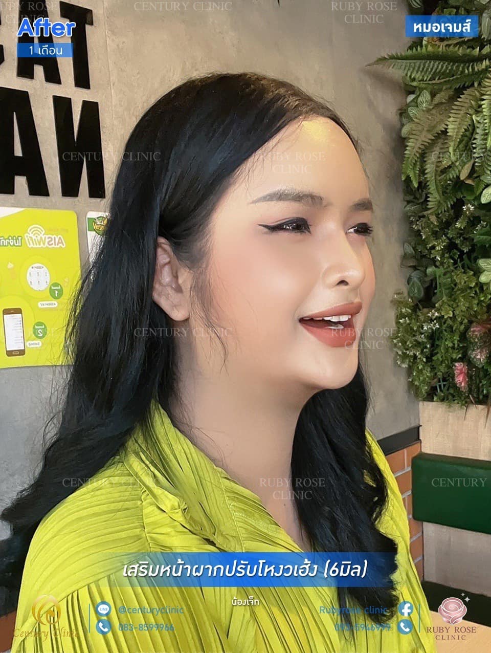 รีวิว เสริมหน้าผากปรับโหงวเฮ้ง #13 , Century Clinic Thailand รีวิว เสริมหน้าผากปรับโหงวเฮ้ง #13