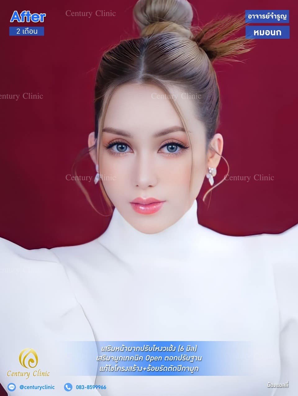 รีวิว เสริมหน้าผากปรับโหงวเฮ้ง #15 , Century Clinic Thailand รีวิว เสริมหน้าผากปรับโหงวเฮ้ง #15
