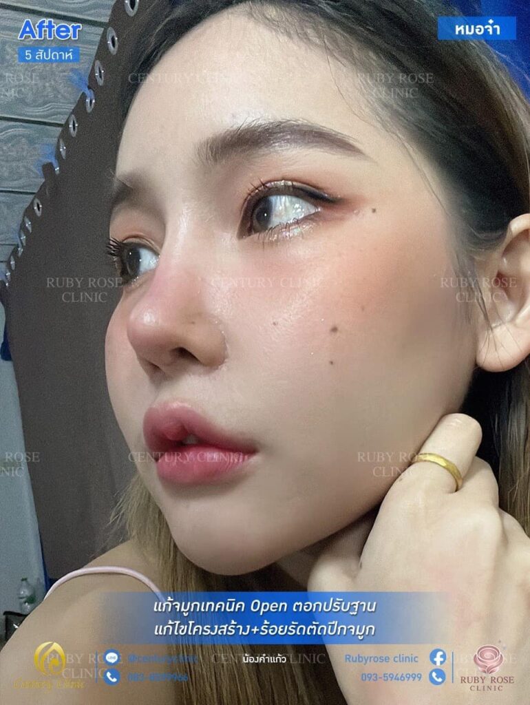 รีวิว แก้จมูก 1 #131