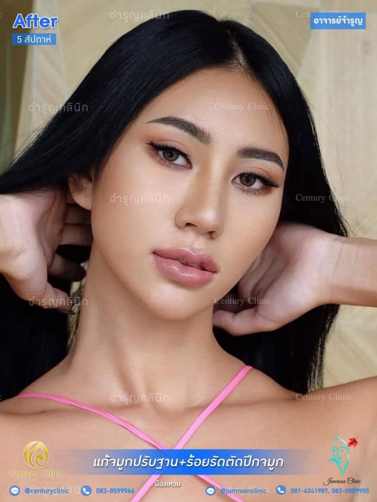 รีวิว แก้จมูก 1 #35