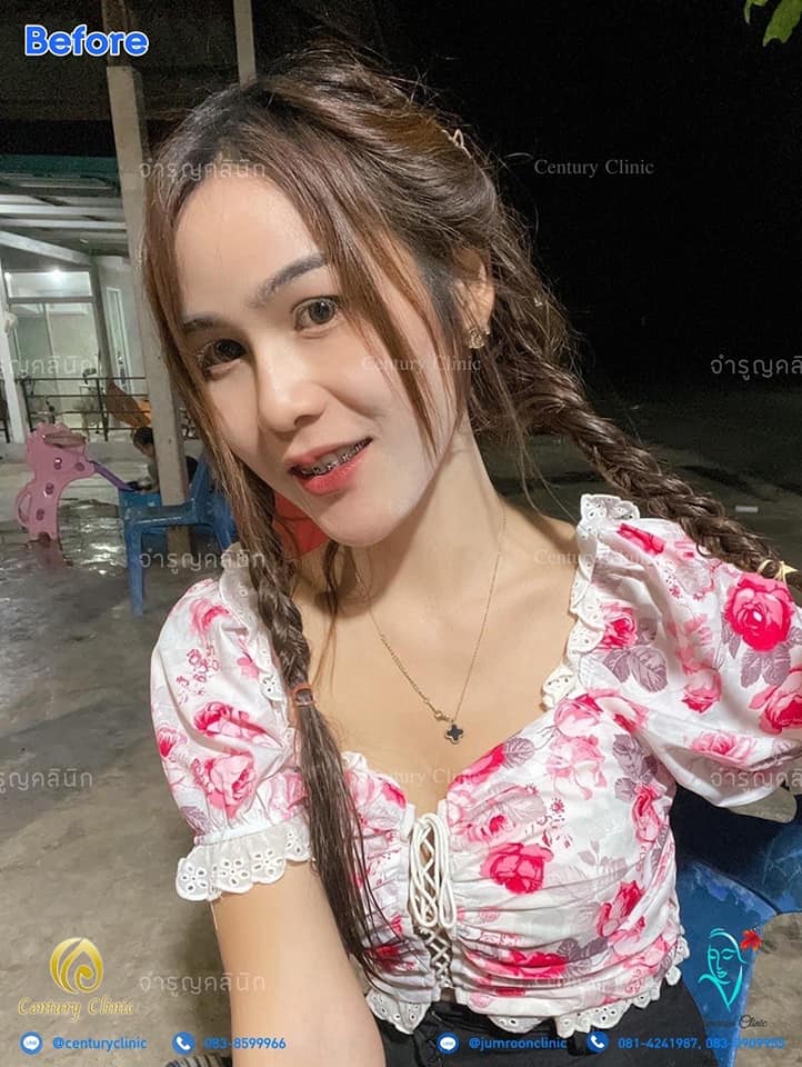รีวิว แก้จมูก 1 #68