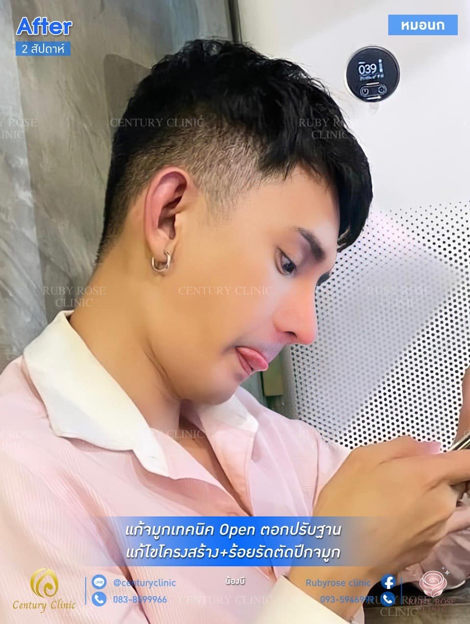 รีวิว แก้จมูก #100