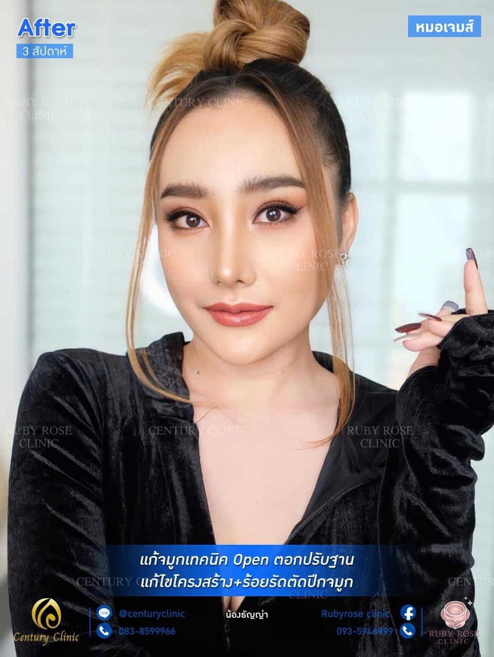 รีวิว แก้จมูก #106
