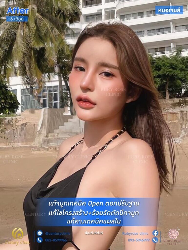 รีวิว แก้จมูก #115 , Century Clinic Thailand รีวิว แก้จมูก 1#115