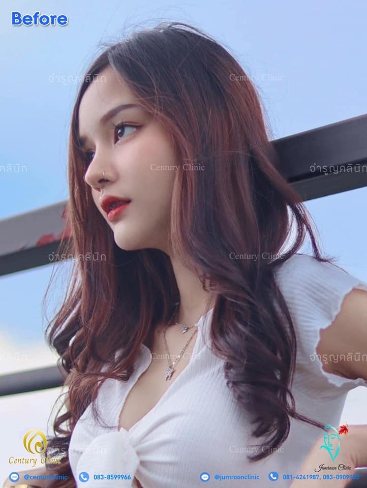 รีวิว แก้จมูก #130 , Century Clinic Thailand รีวิว แก้จมูก 1#130