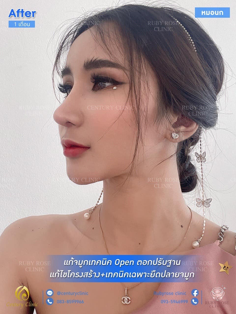 รีวิว แก้จมูก #116
