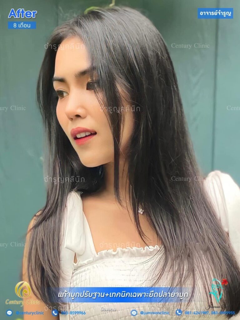 รีวิว แก้จมูก #117