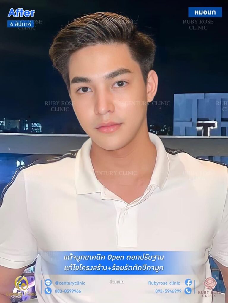 รีวิว แก้จมูก 2#122