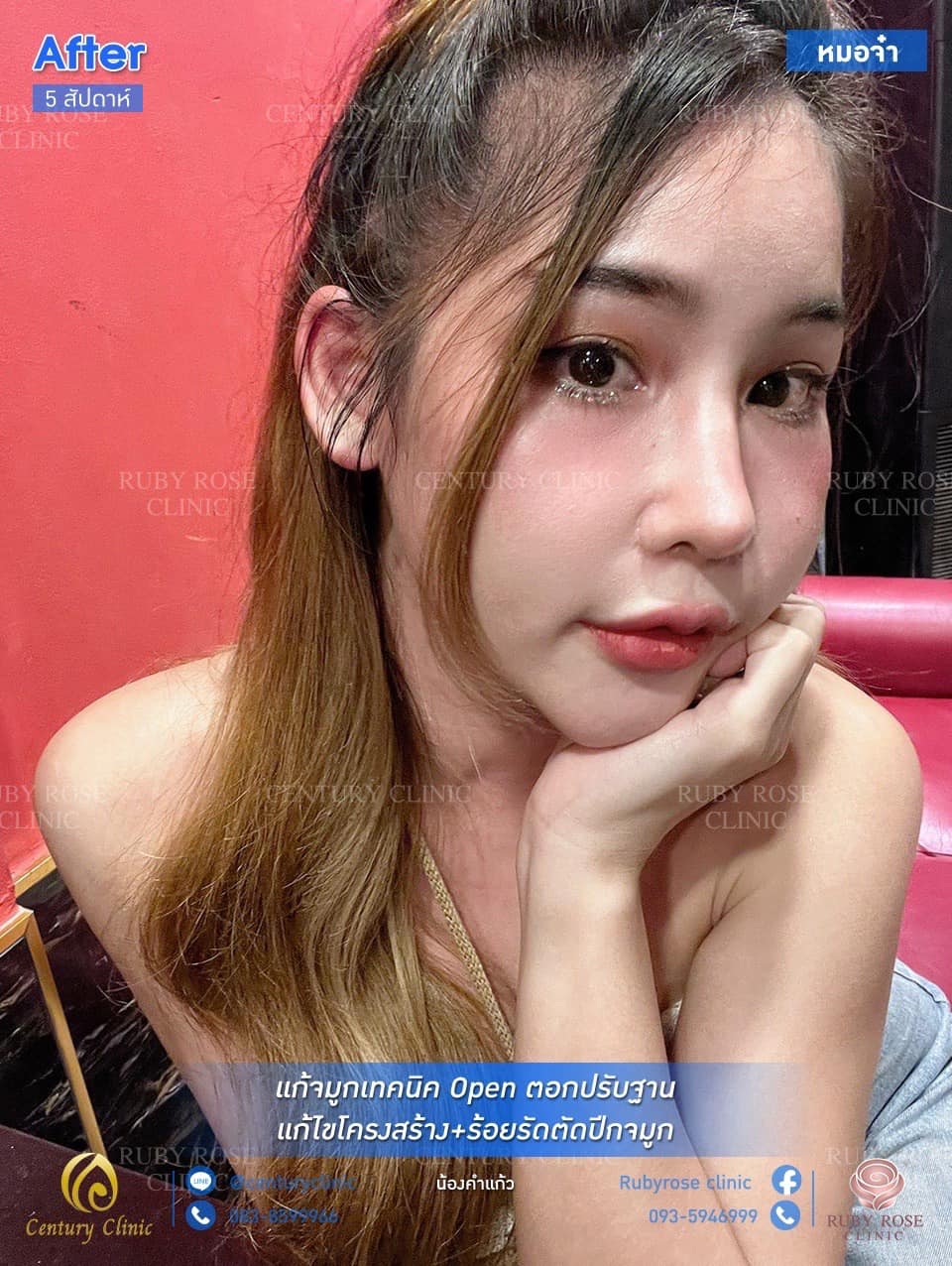 รีวิว แก้จมูก #131