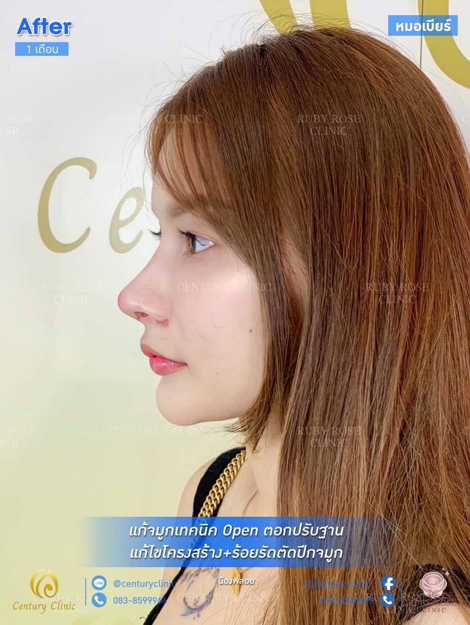 รีวิว แก้จมูก #132