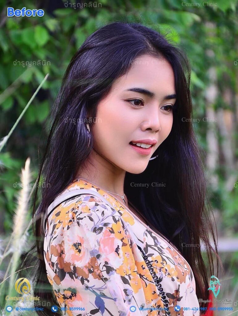 รีวิว แก้จมูก #117 , Century Clinic Thailand รีวิว แก้จมูก 2 #117