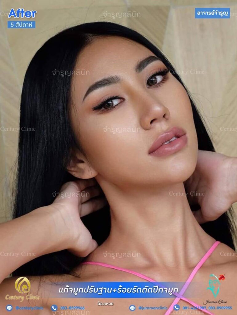 รีวิว แก้จมูก 2 #35