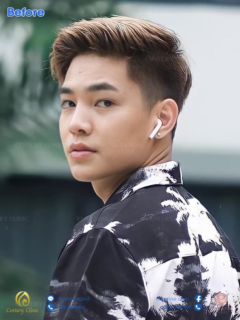รีวิว แก้จมูก 2#122