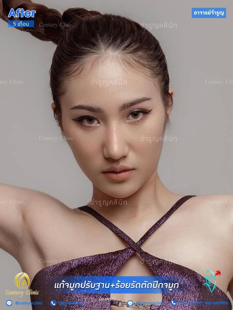 รีวิว แก้จมูก #25
