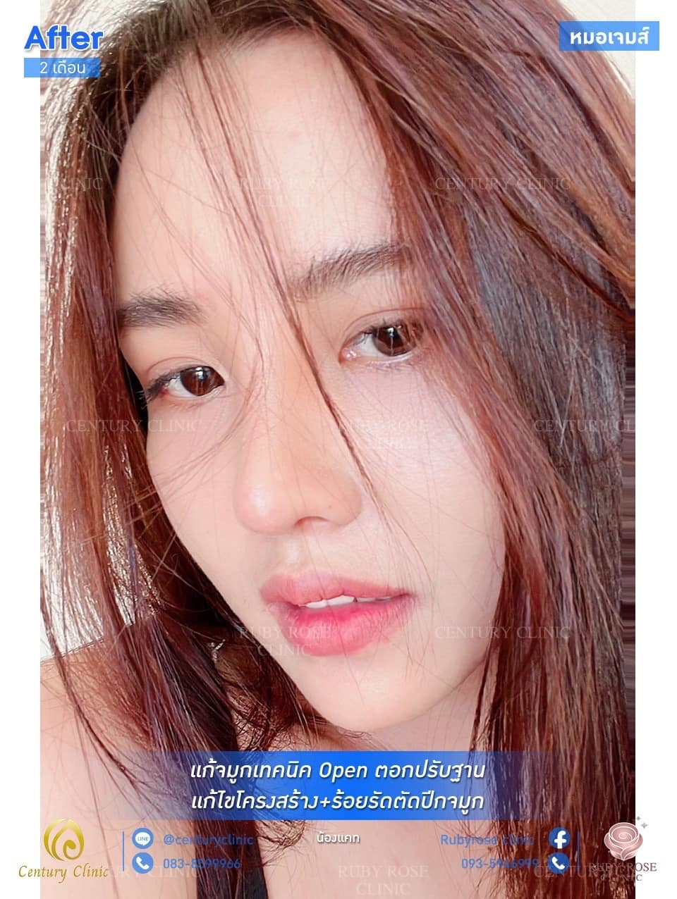 รีวิว เสริมจมูก #28 , Century Clinic Thailand รีวิว แก้จมูก #28