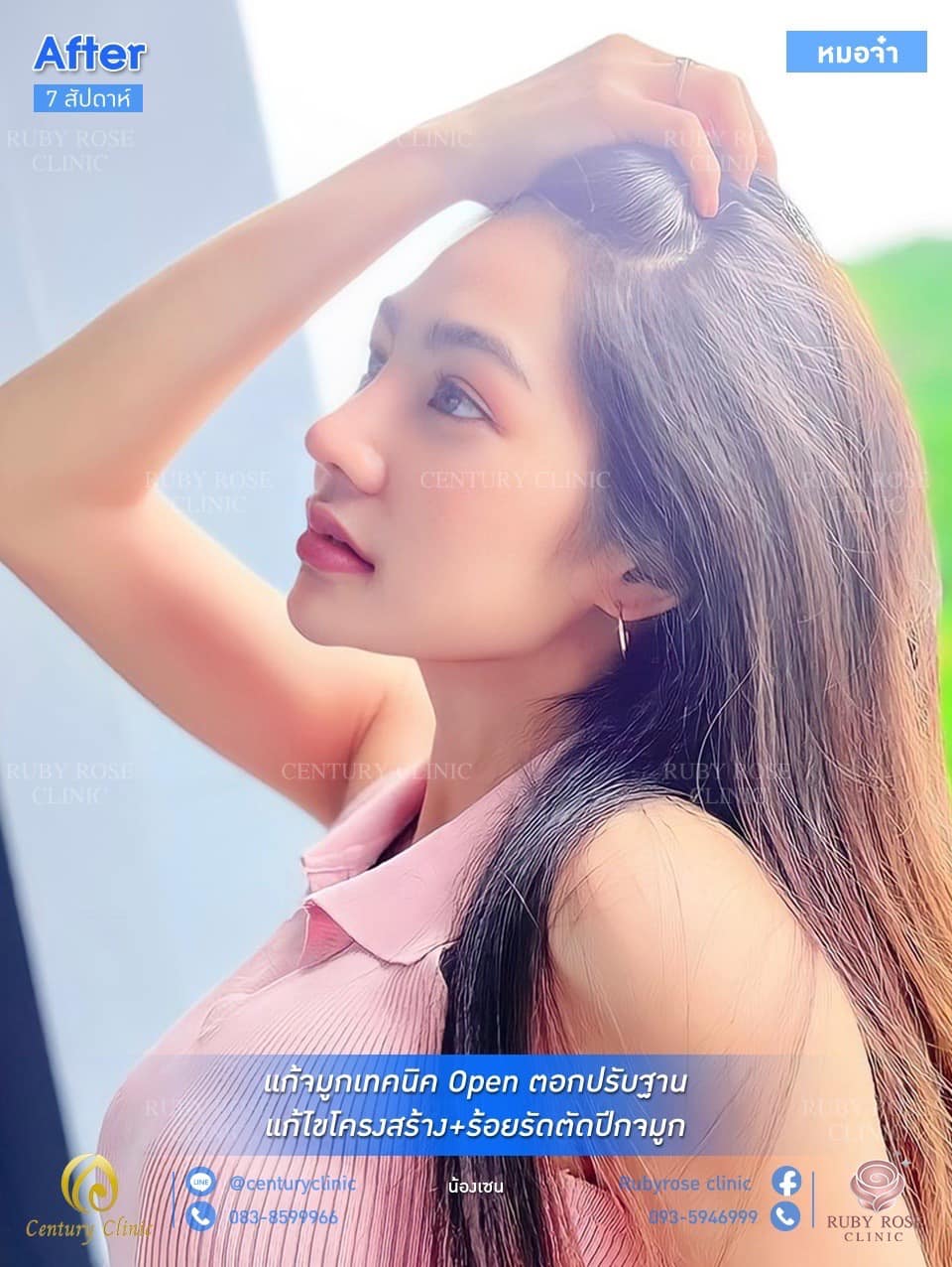 รีวิว แก้จมูก #29