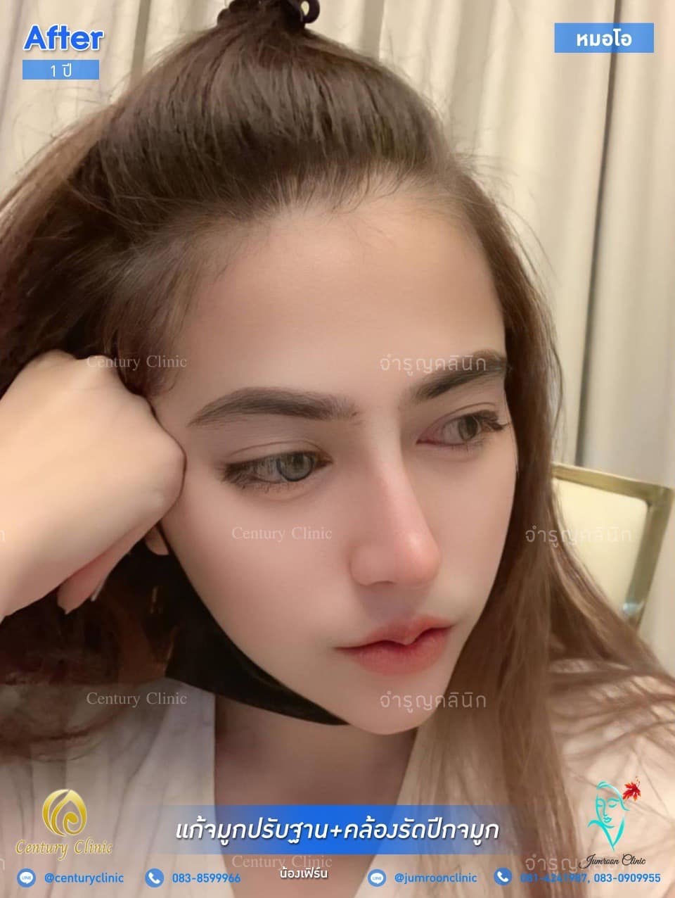 รีวิว แก้จมูก #31