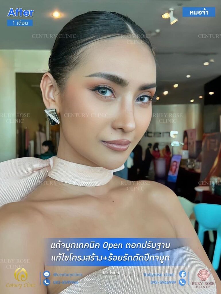 รีวิว แก้จมูก 3#104