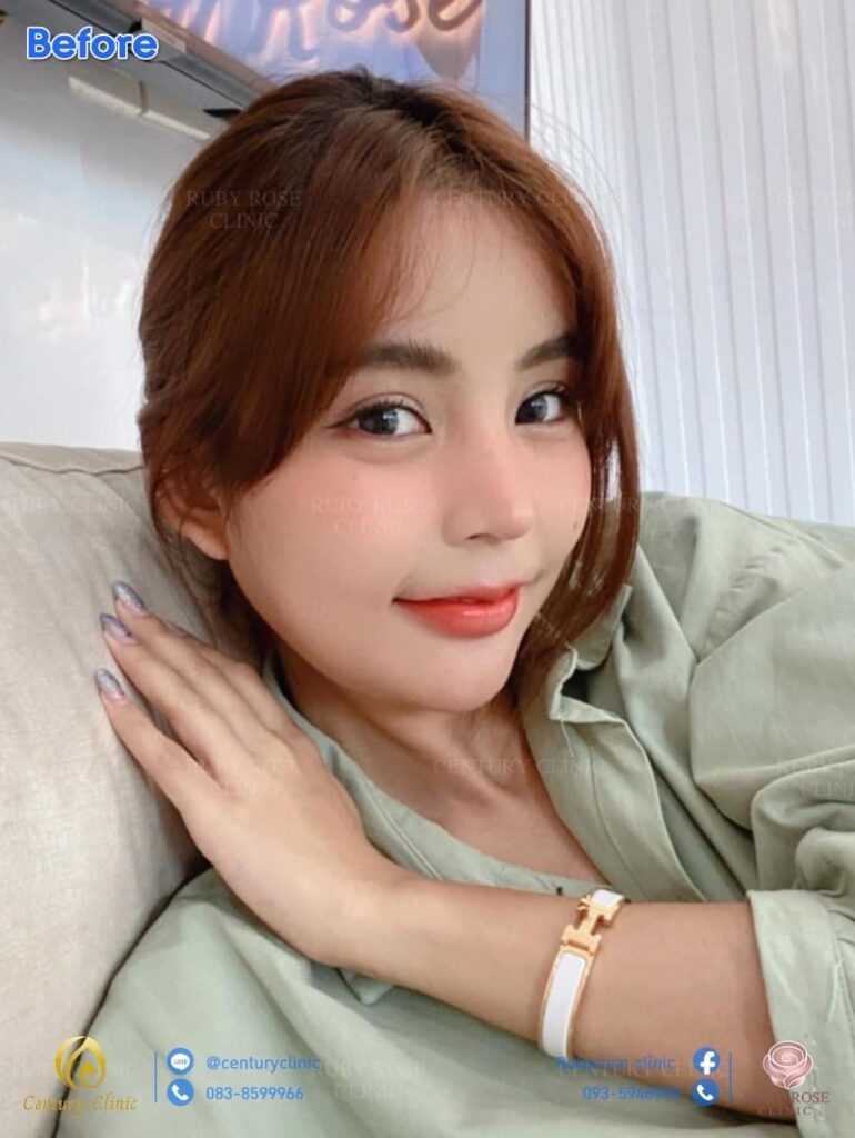 รีวิว แก้จมูก #115 , Century Clinic Thailand รีวิว แก้จมูก 3#115
