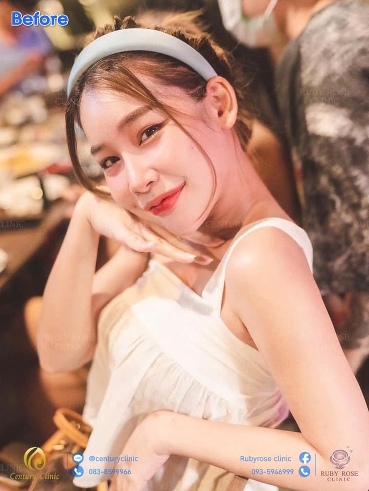 รีวิว แก้จมูก 3#131