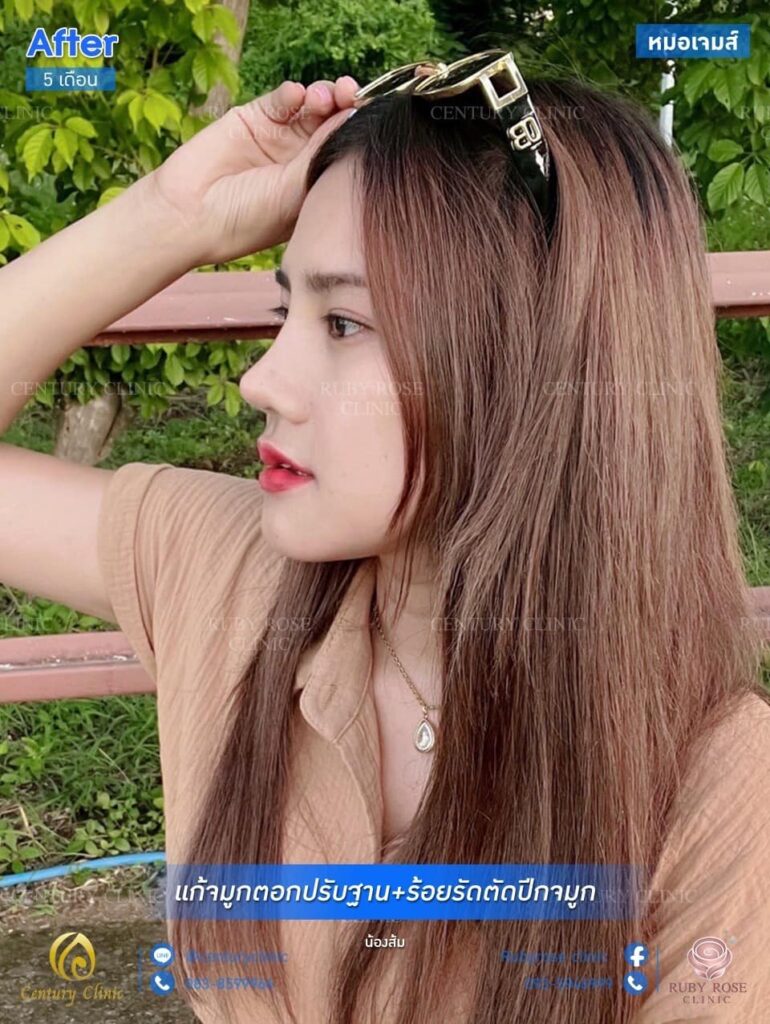 รีวิว แก้จมูก #33 , Century Clinic Thailand รีวิว แก้จมูก #33.1