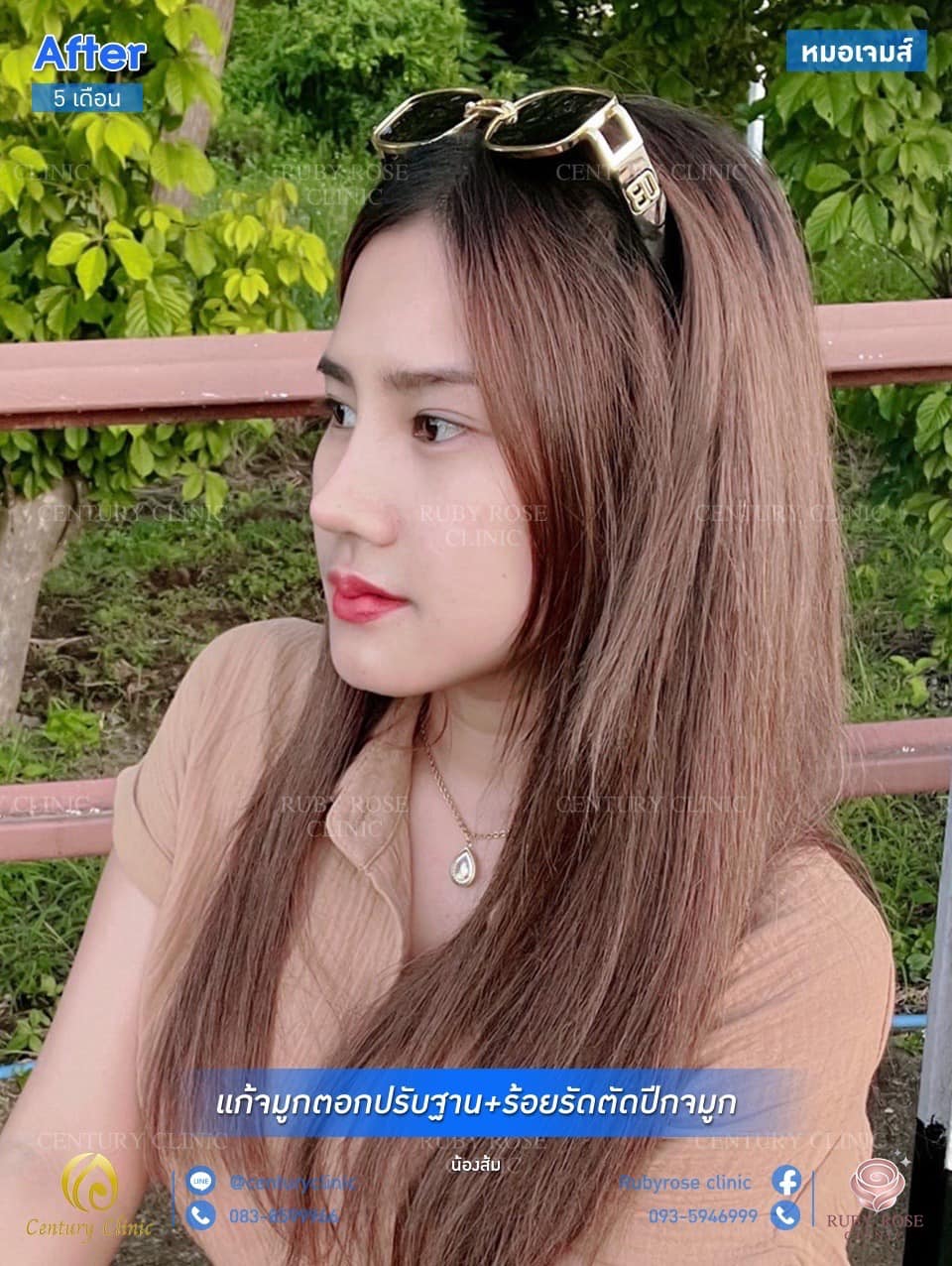 รีวิว แก้จมูก #33 , Century Clinic Thailand รีวิว แก้จมูก #33