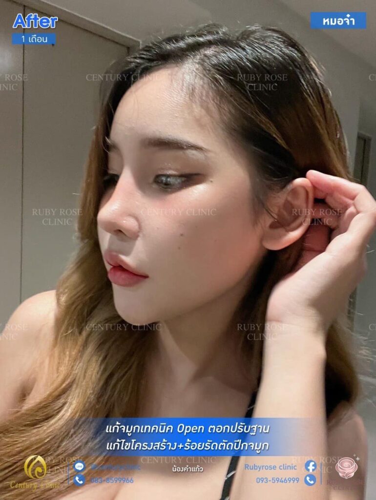รีวิว แก้จมูก #34.1