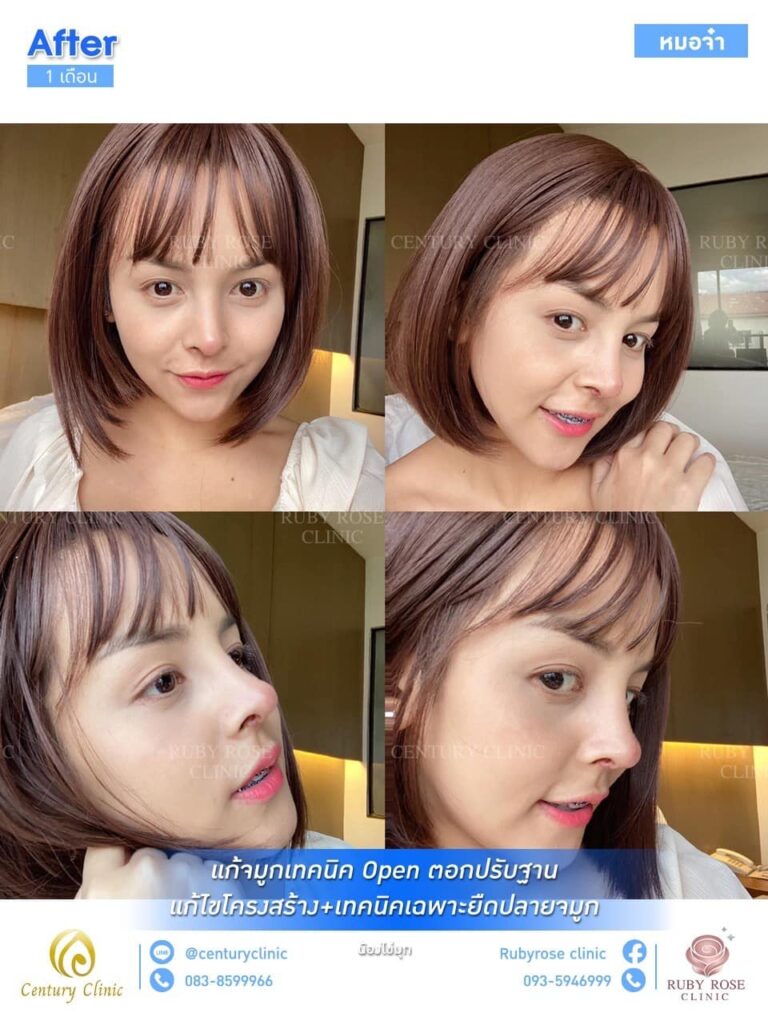 รีวิว แก้จมูก #38