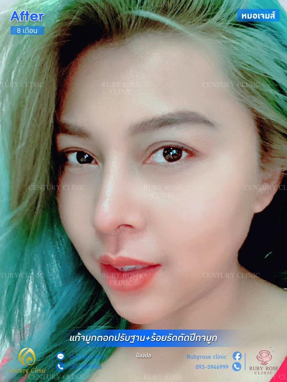 รีวิว แก้จมูก #54 , Century Clinic Thailand รีวิว แก้จมูก #54