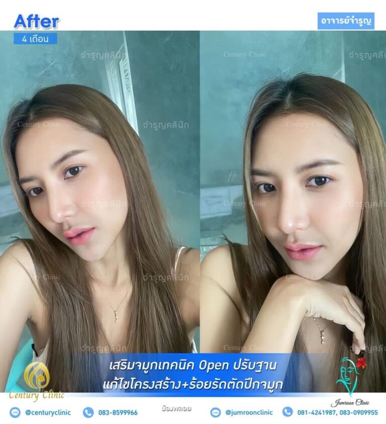 รีวิว แก้จมูก #55