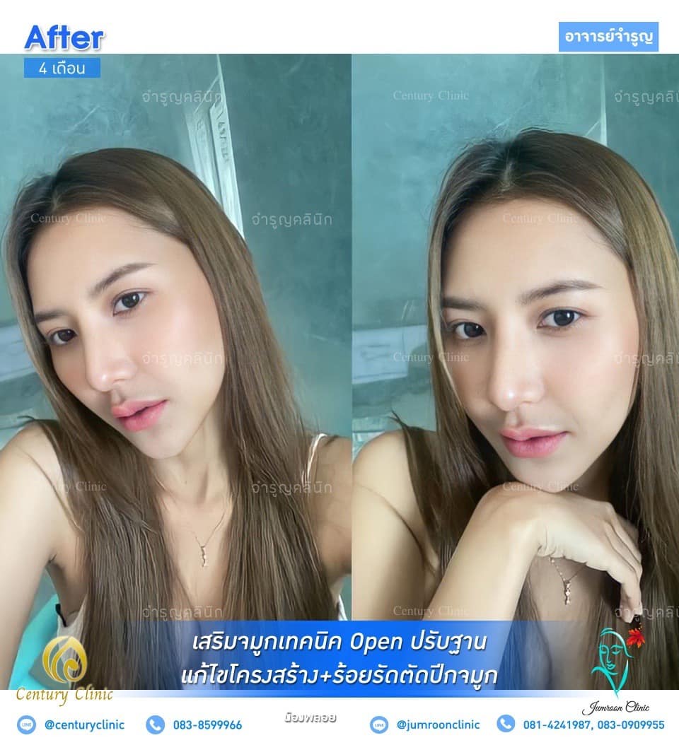 รีวิว แก้จมูก #55