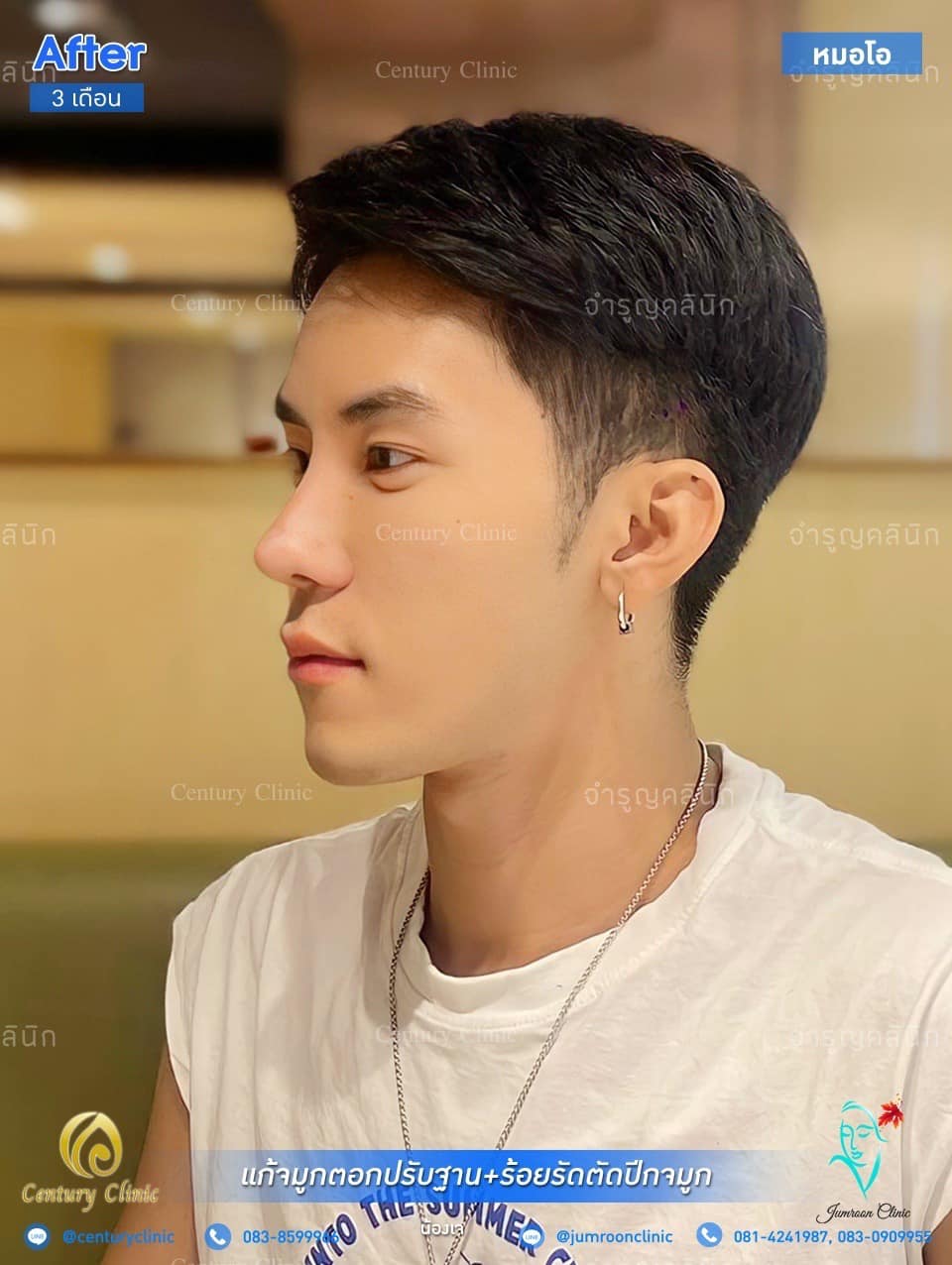 รีวิว แก้จมูก #58