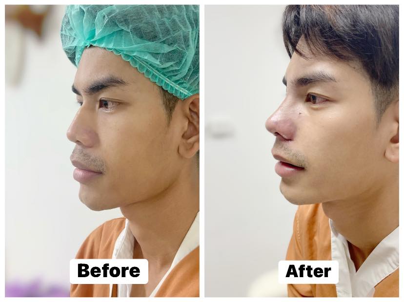 รีวิว เสริมจมูก #61 , Century Clinic Thailand รีวิว แก้จมูก #62