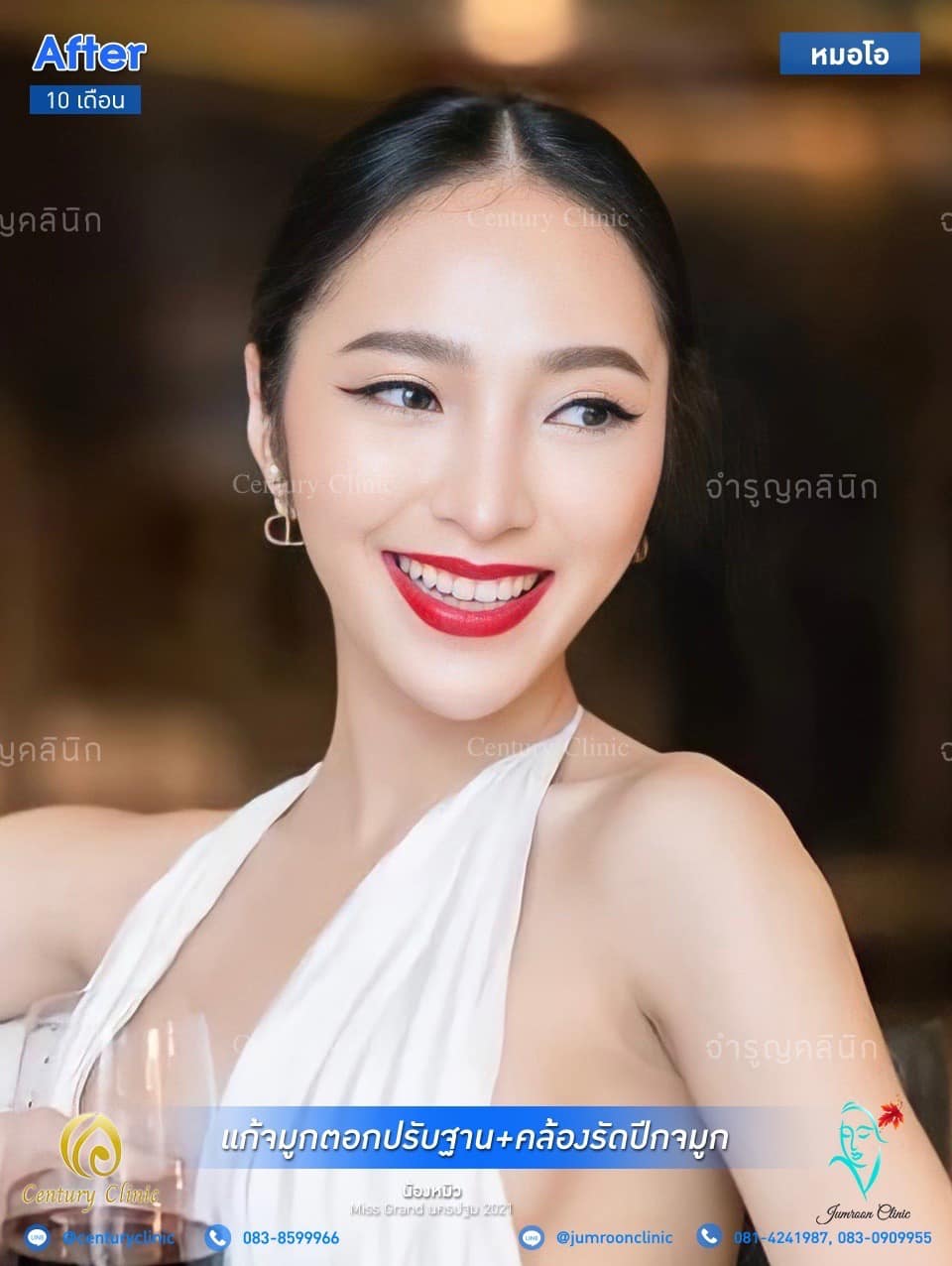 รีวิว แก้จมูก #64
