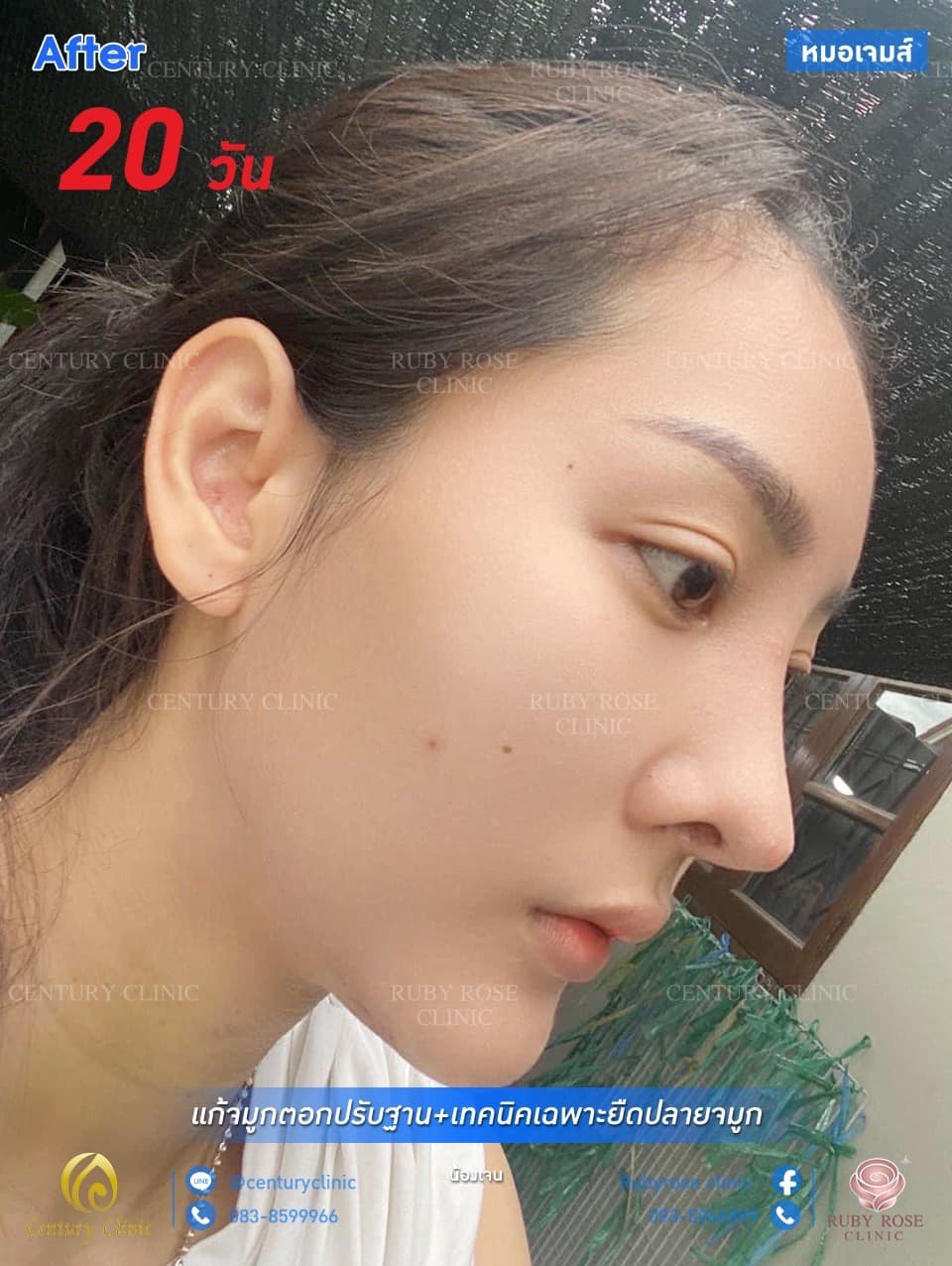 รีวิว แก้จมูก #65 , Century Clinic Thailand รีวิว แก้จมูก #65