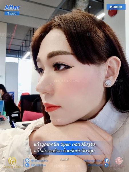รีวิว แก้จมูก #66