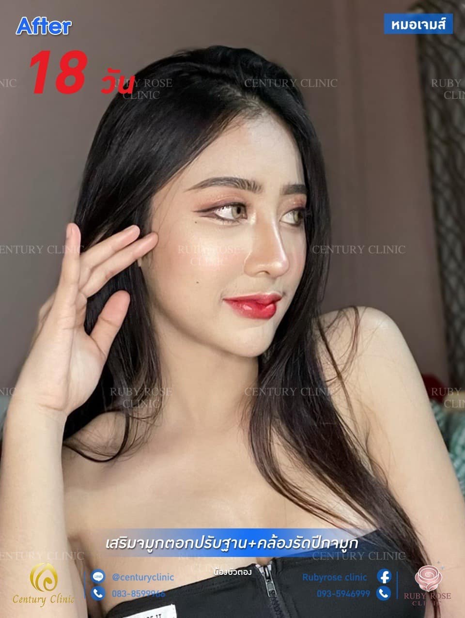 รีวิว แก้จมูก #70
