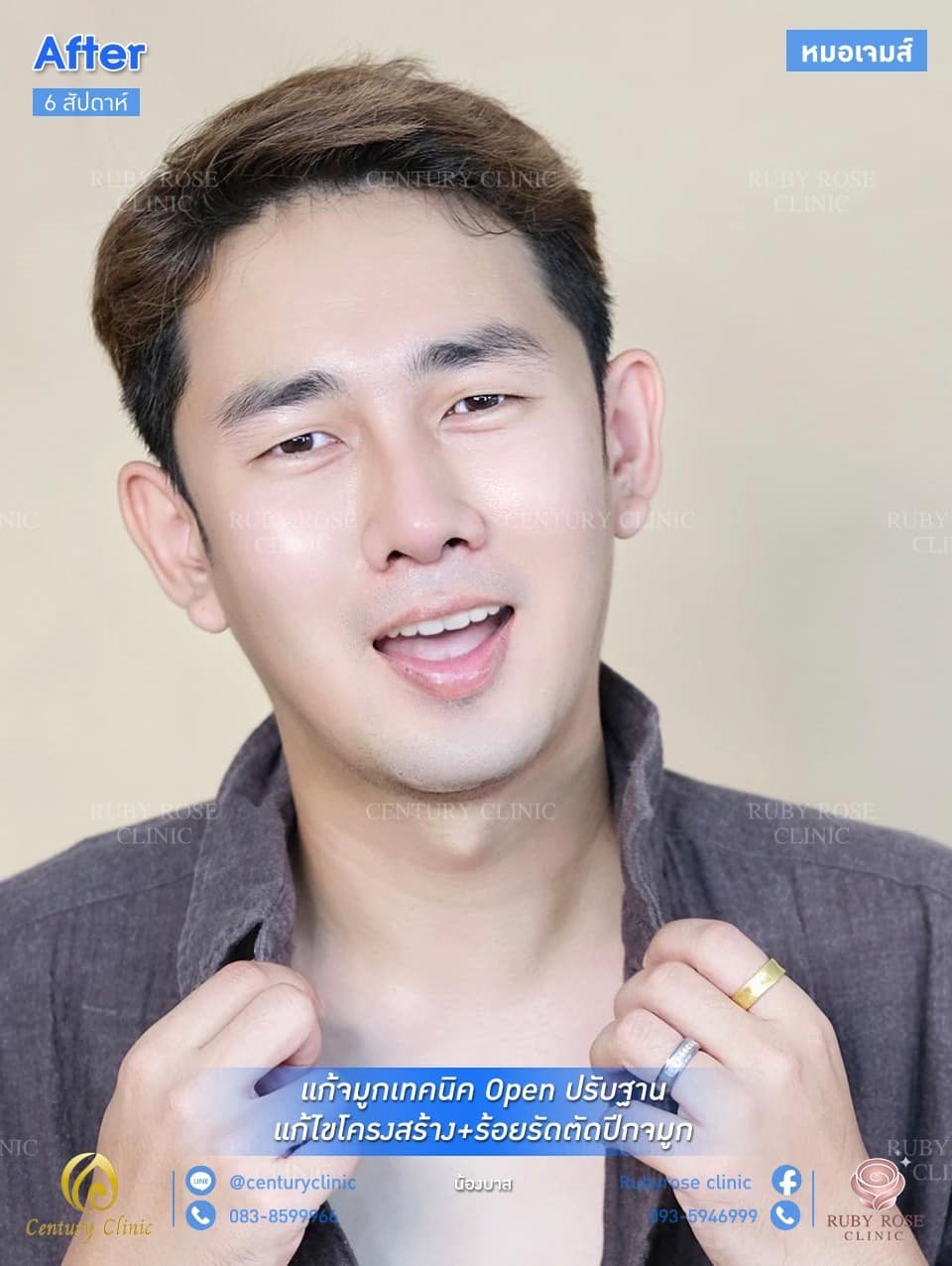 รีวิว แก้จมูก #76 , Century Clinic Thailand รีวิว แก้จมูก #76