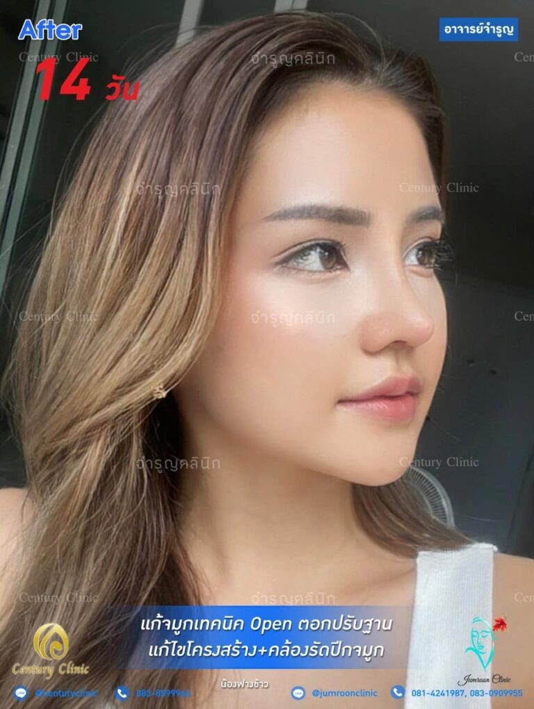 รีวิว แก้จมูก1 #77