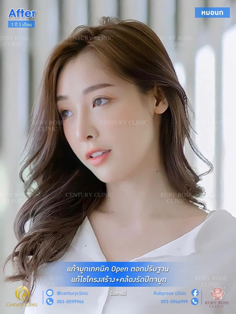 รีวิว แก้จมูก #78 , Century Clinic Thailand Century Clinic Thailand