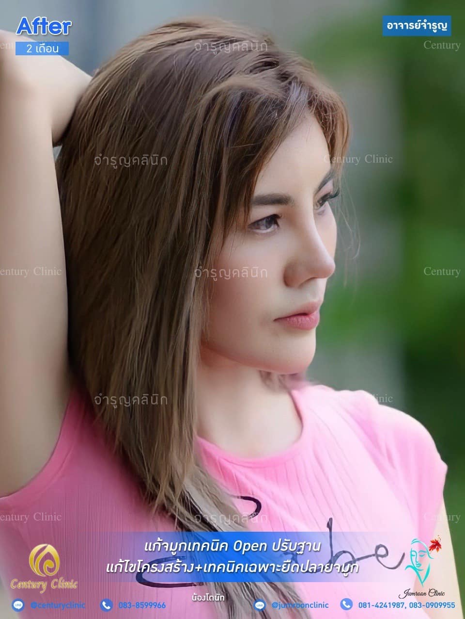 รีวิว แก้จมูก #85 , Century Clinic Thailand รีวิว แก้จมูก #86