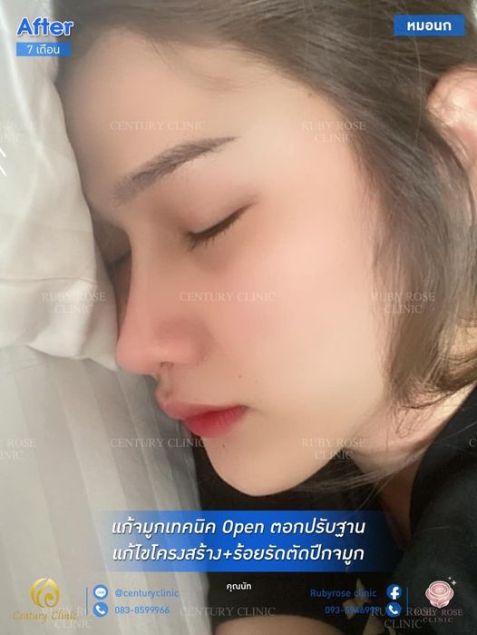 รีวิว แก้จมูก #88