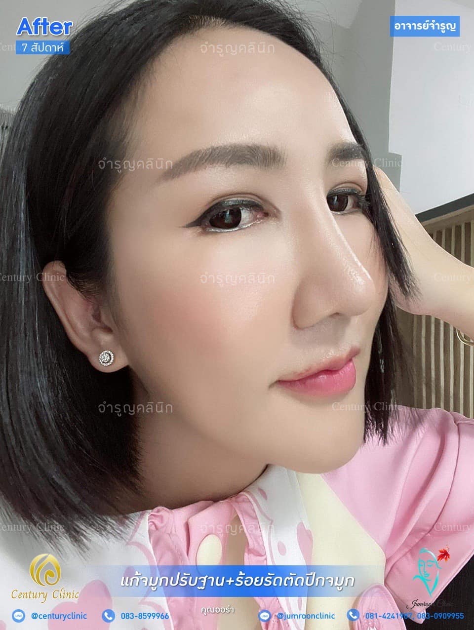รีวิว แก้จมูก #89 , Century Clinic Thailand Century Clinic Thailand