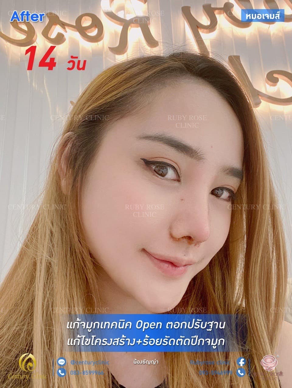 รีวิว แก้จมูก #91 , Century Clinic Thailand รีวิว แก้จมูก #91