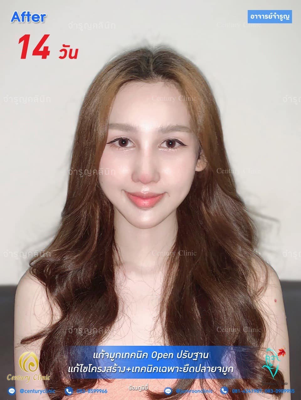 รีวิว แก้จมูก #92