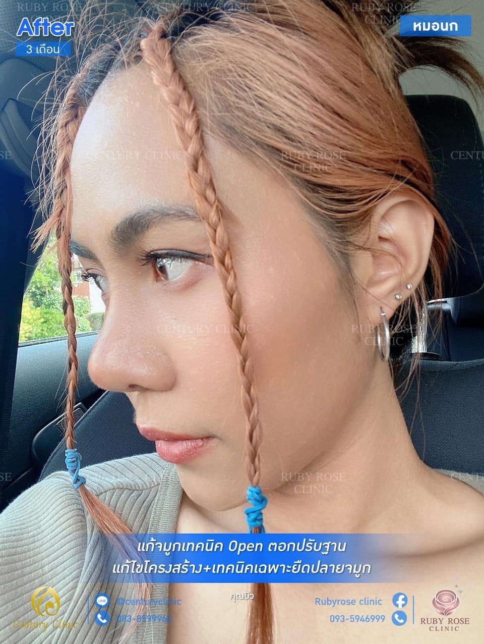 รีวิว แก้จมูก2 #93