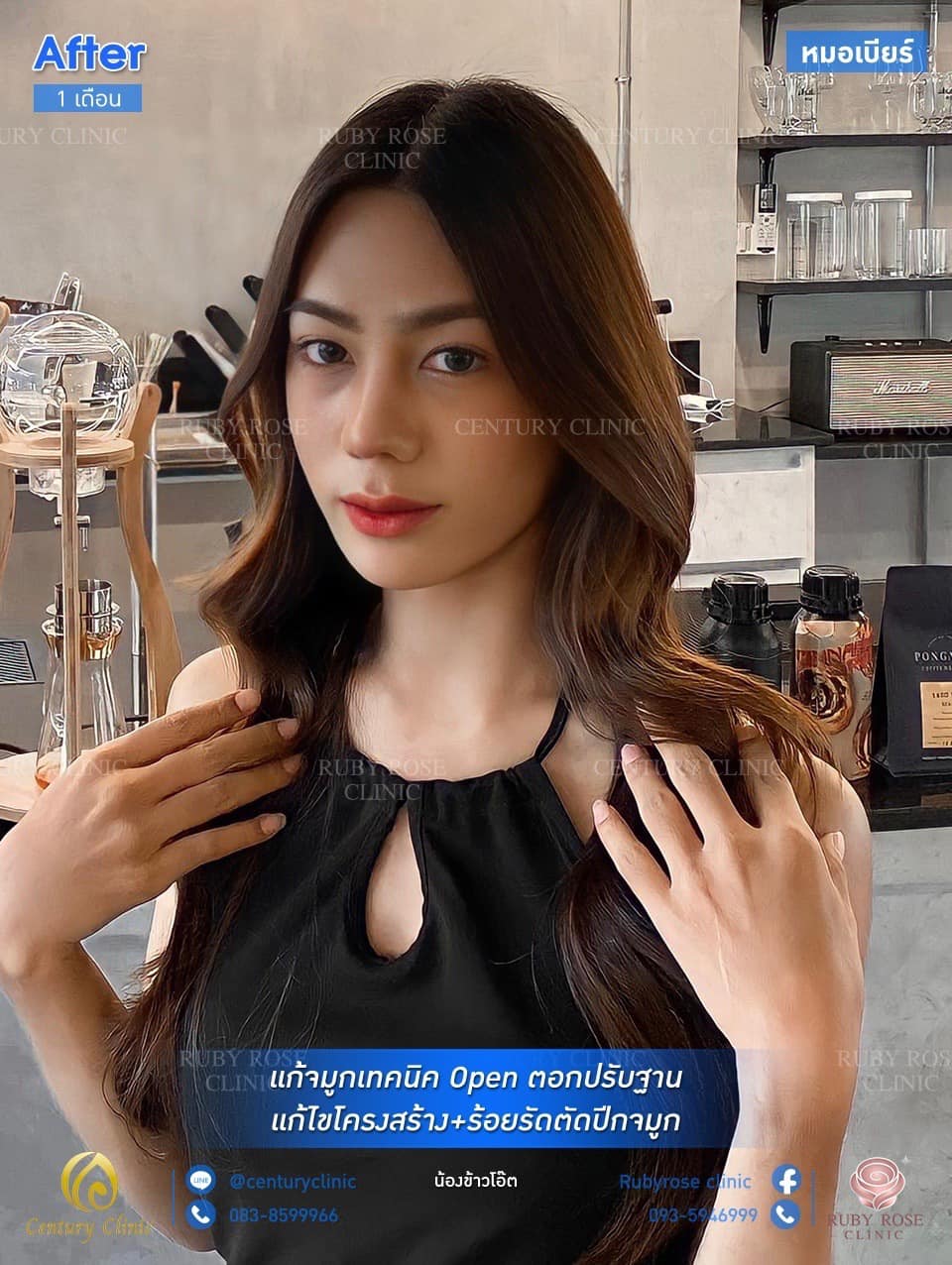 รีวิว แก้จมูก #99