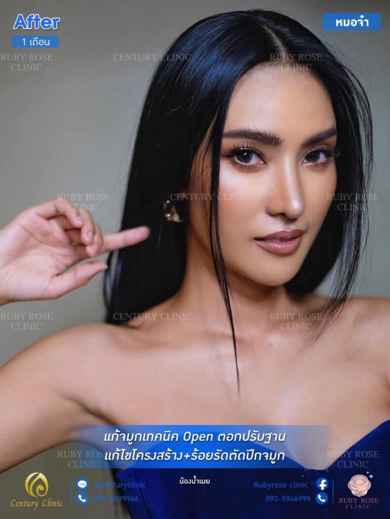 รีวิว แก้จมูก1 #104