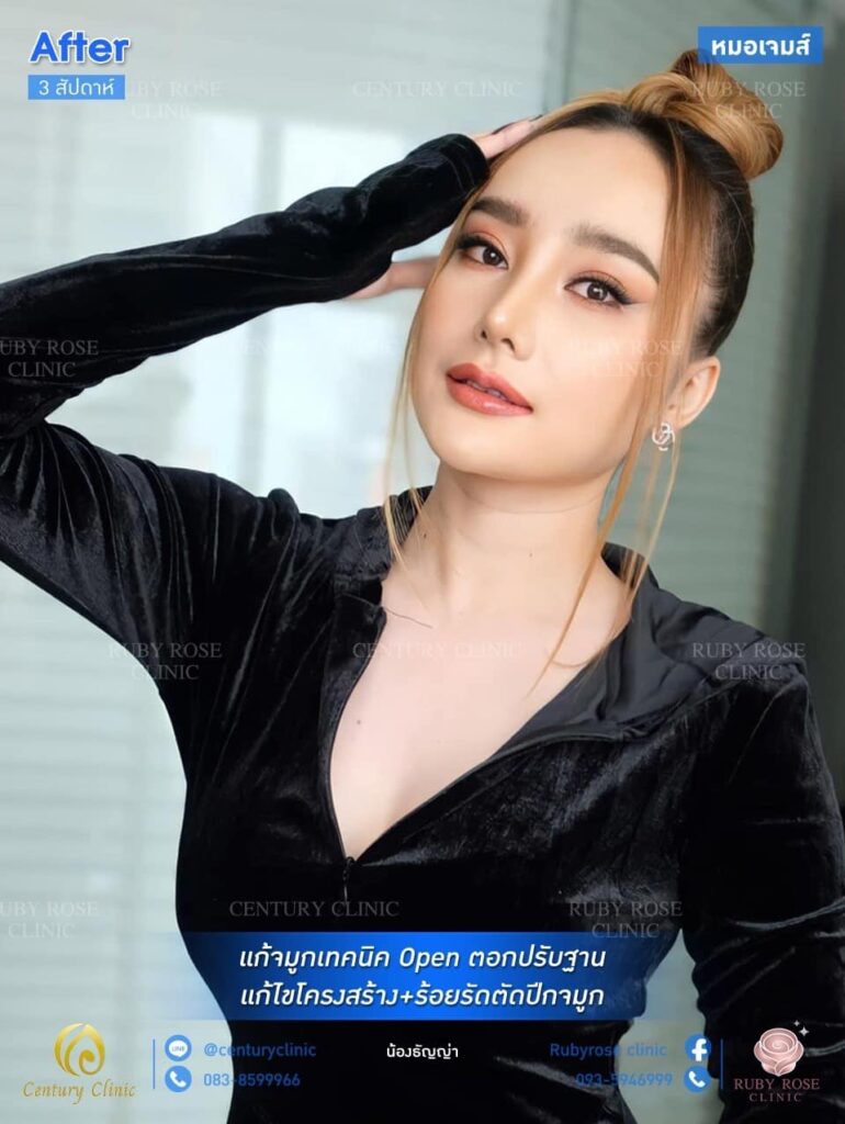 รีวิว แก้จมูก1 #106
